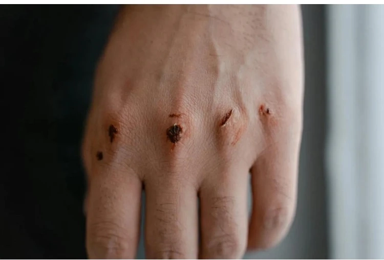 Son 30 Yılda Uyuz vakaları Pik yaptı, Gaziantep için Kritik uyarılar