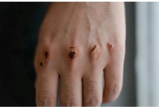 Son 30 Yılda Uyuz vakaları Pik yaptı, Gaziantep i&ccedil;in Kritik uyarılar